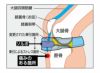 ソルボフィットバンド膝 オスグッド 解説